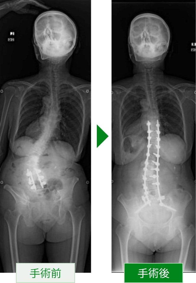 脊柱変性側弯症・後弯症 症例写真1