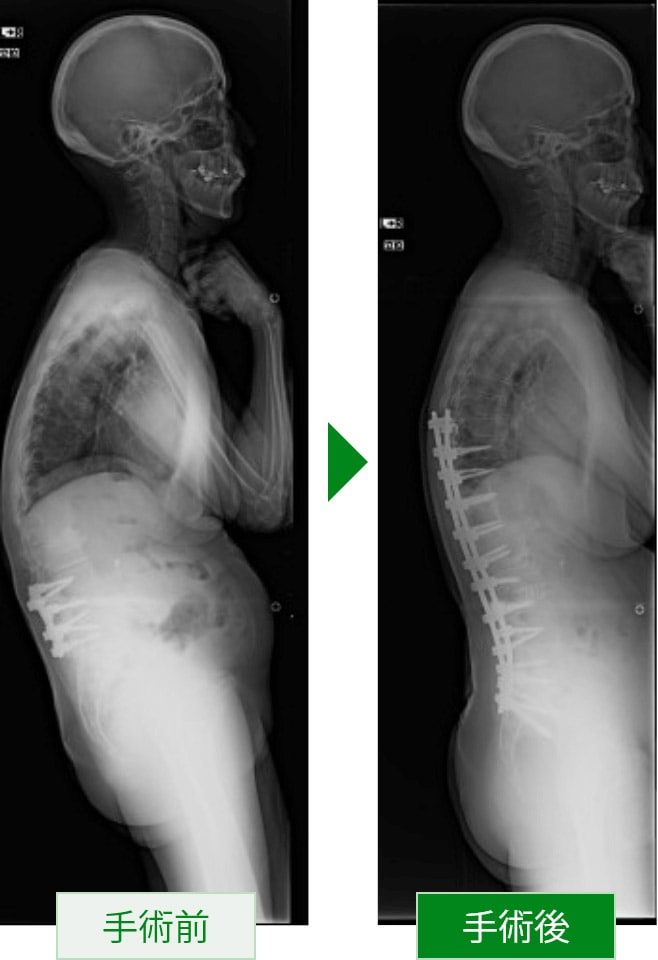 脊柱変性側弯症・後弯症 症例写真2