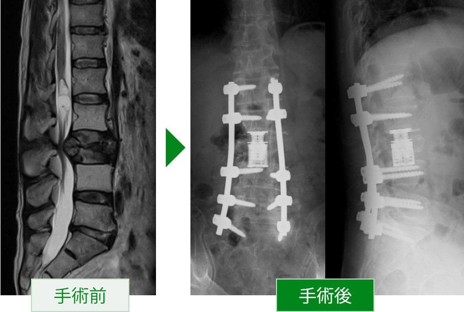 転移性脊椎腫瘍による脊椎破裂骨折 症例写真