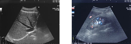 腹部超音波検査　検査時間20〜30分